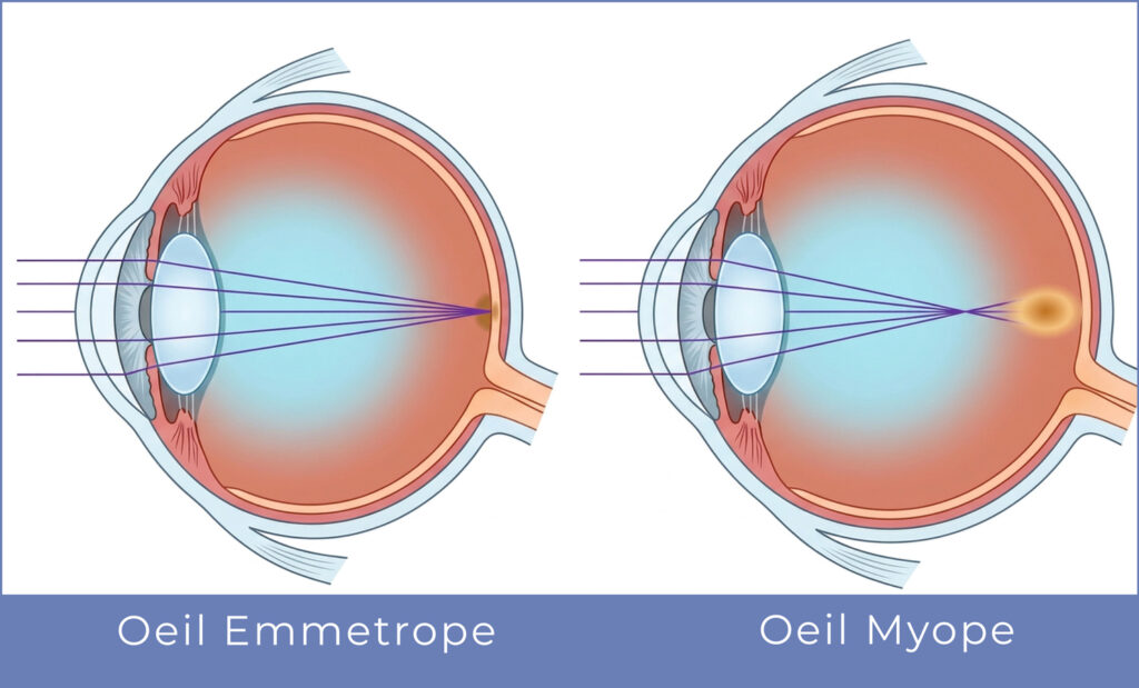 Oeil myope